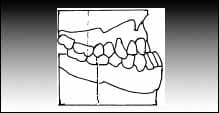 Maloclusiones Dentales, Clase 3 de Angle.