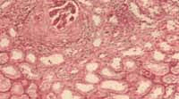 Micofotografia de la biopsia renal con un glomérulo hipercelular