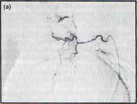 Arteriografía bronquial derecha, muestra dilatación y tortuosidad de las ramas bronquiales
