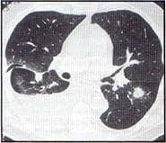 nódulos pulmonares, infección por aspergilus