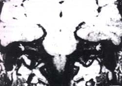 Proyección coronal de imagen de RM