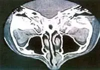 TAC de cabeza. Adenoma pleomorfo en el septum nasal