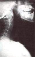 Rx lateral de cuello