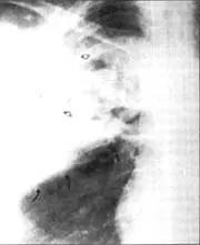 Neumonía necrotizante por K. pneumonie