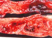 Aspecto macroscópico de la lesión del intestino delgado