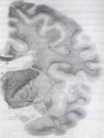 Sección coronal del hemisferio cerebral izquierdo