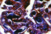  Fotomicrografía de un glomérulo renal con trombos de fibrina
