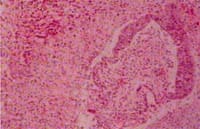 imagen característica del daño alveolar difuso