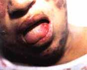 Ulceras orales
