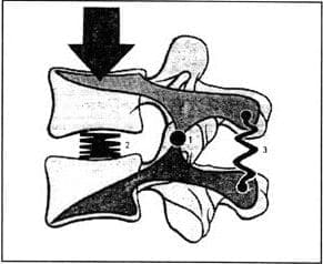 Representación de unidad vertebral como palanca de primer grado