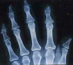 Radiografia de manos donde se aprecia osteolisis de falanges distales