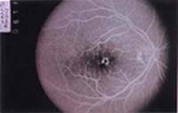 Toxicidad retiniana en "Ojo de buey" ocasionada por cloroquina.