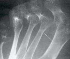 Osteopenia yuxtaarticular, erosiones múltiples y subluxaciones de los metatarsianos