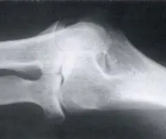 Codo. Osteopenia yuxta-articular, disminución simétrica del espacio articular.