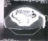 Tac abdominal. S.N. paciente de 32 años, con un lupus que se inició a los 18 años.