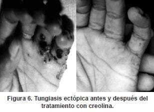 Tungiasis ectópica en tratamiento