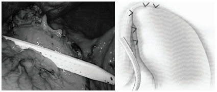 Fundoplicatura parcial anterior y drenaje activo blando
