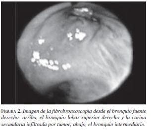 Imagen de la Fibrobroncoscopia desde el Bronquio