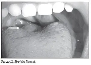 Tiroides Lingual