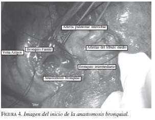 Imagen Inicio la Anastomosis Bronquial