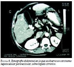 Tomografía Abdominal en la que se Observa un Carcinoma