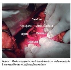Derivación Portocava con Endoprotesis