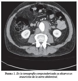 En la tomografía Aneurisma de la aorta abdominal