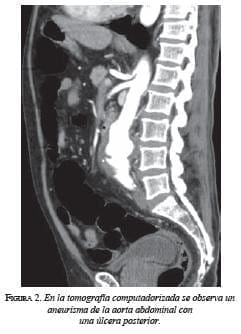 En la tomografía Aneurisma de la aorta abdominal con Úlcera