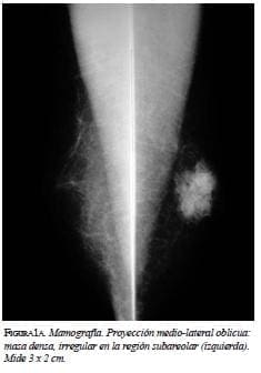 Mamografía proyección medio lateral oblicua