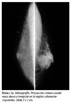 Mamografía proyección cráneo - caudal