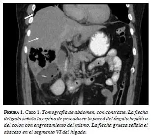 Tomografía de abdomen Caso 1