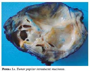 Tumor papilar intraductal mucinoso