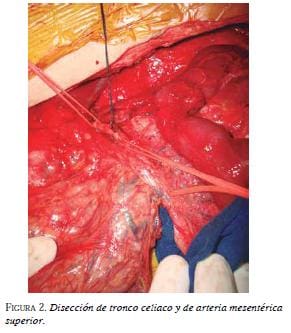 Disección tronco celiaco