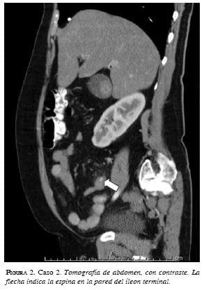 Tomografía de abdomen Caso 2