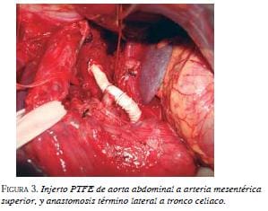 Injerto PTFE de aorta abdominal
