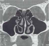 sintomatología rinosinusal recurrente