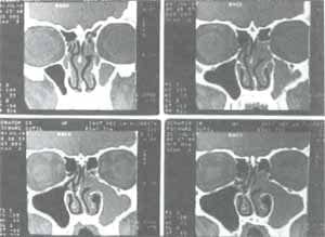 desviación septal derecha y mucocele maxilo etmoidal contralateral