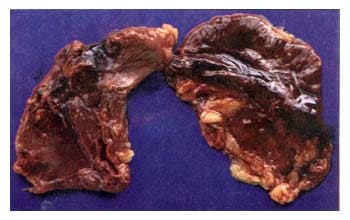 Glándulas suprarrenales: Hemorragia masiva bilateral