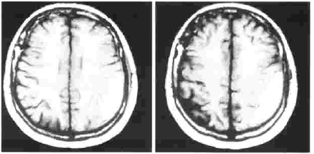 Resonancia magnética cerebral inicial
