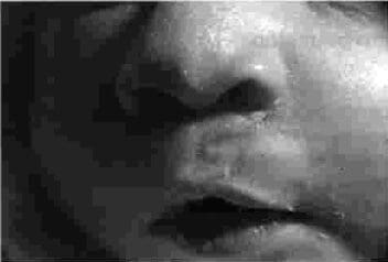 Postoperatorio de labio alveolo paladar Postoperatorio de labio alveolo paladar