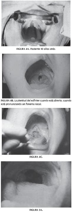 Cirugía de esfínter muscular de faringe