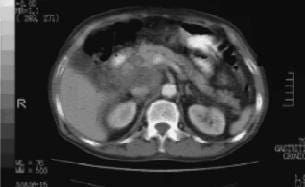 Tomografía de Abdomen en la que se Aprecia una Lesión Quística en la Cabeza de Páncreas
