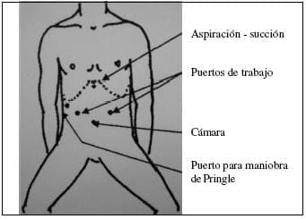 Posición del Paciente en Cirugía y colocación de los Puertos Laparoscópicos