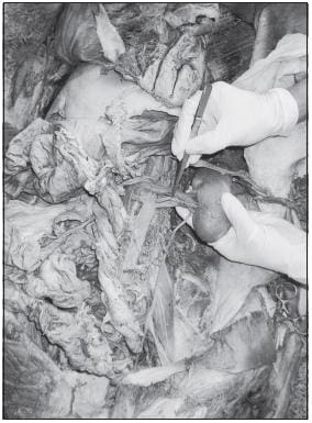 Arteria Renal Doble: Las arterias renales múltiples son variantes frecuentes con un predominio de 30 a 40%