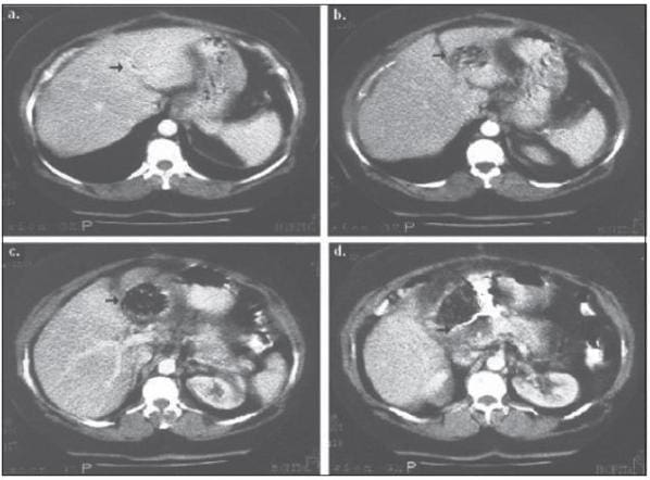 tomografia com contraste abdomen