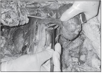 Arteria Renal Doble: Las arterias son de gran volumen