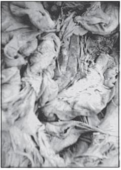  Arteria Rectal Superior De La Sigmoidea
