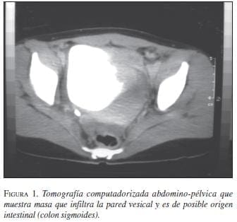 Tomografía Computarizada Abdomino-Pélvica que muestra masa que infiltra Pared Vesícal