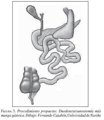 Procedimiento Propuesto Duodenoyeyunostomía más Manga Gástrica