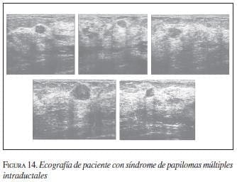 Papiloma ductal intraquistico - Papiloma humano numero 11 - Que es un papiloma intraquistico
